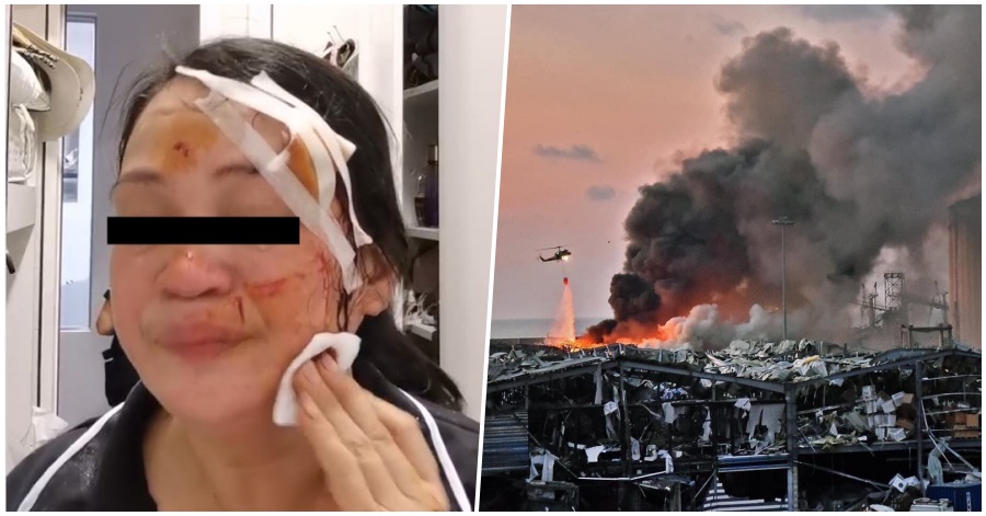 [Video] Pinay OFW Shares Her Experiences, Bares Wounds Sustained from Beirut Blast